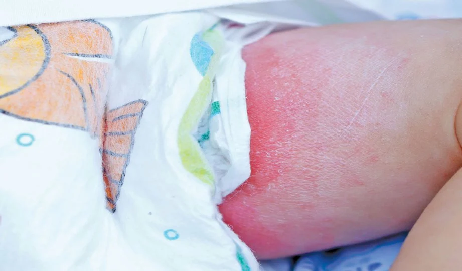 Ruam Bayi Di Punggung Buat Ibu Risau? Ini Tips Mengatasinya